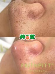 -凡碧诗毛孔清洁收细