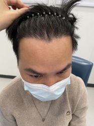 体验后-大麦微针植发全国连锁
