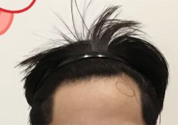 -大麦微针植发全国连锁