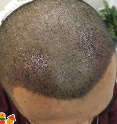 -大麦微针植发丨全国连锁