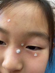 -北京美痣堂古方祛痣斑疣瘊