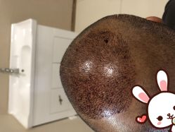 点击看大图 -大麦微针植发丨全国连锁