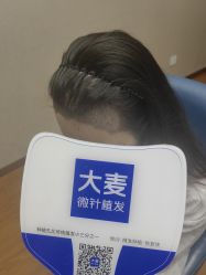 -大麦微针植发全国连锁