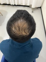 体验前-大麦微针植发全国连锁