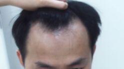 体验前-雍禾植发全国连锁