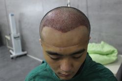 点击看大图 -大麦微针植发丨全国连锁