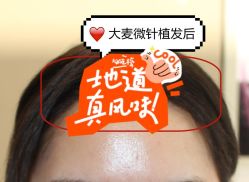 -大麦微针植发全国连锁