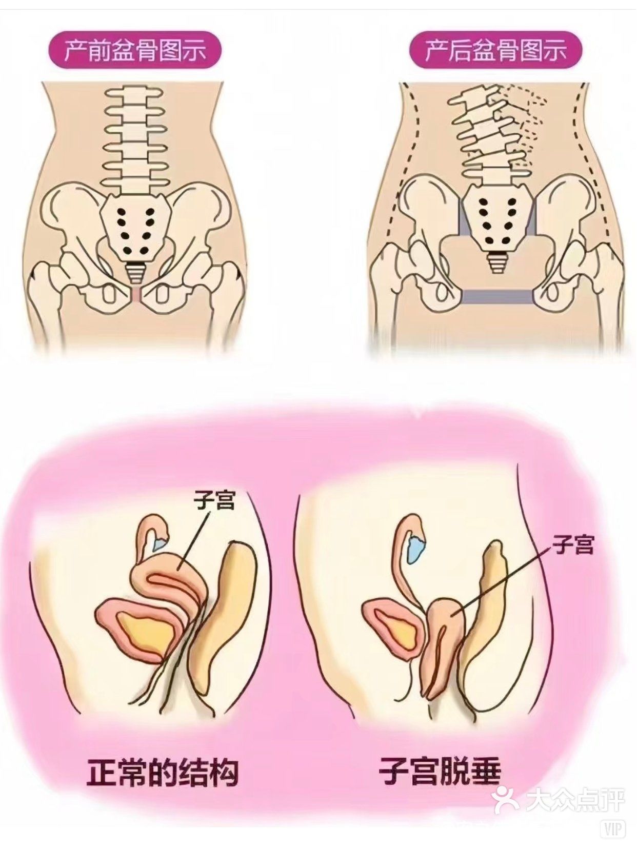 产后宫腔分离图片