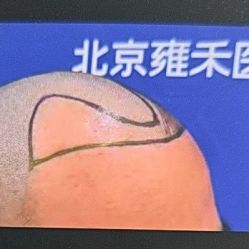 -北京雍禾植发医院