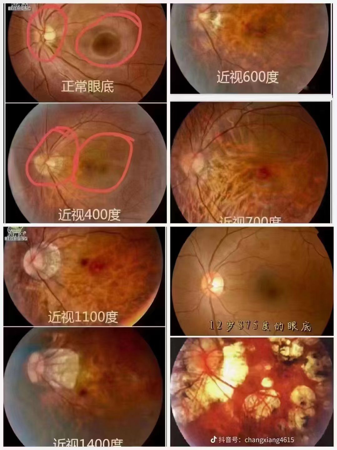 可怕的是近视所带来的眼底的变化,高度近视所带来的眼底病变是现代