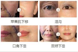 年轻化对比案例-加减美医美连锁品牌