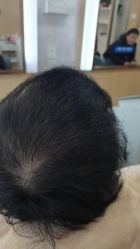 -大麦微针植发丨全国连锁