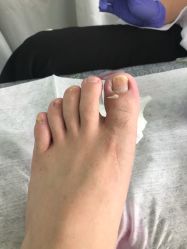 -德哥灰指甲脚气甲沟炎跖疣护理