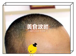 -大麦微针植发全国连锁