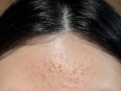 -成都苗方清颜专业祛痘