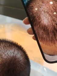 -碧莲盛·不剃发植发