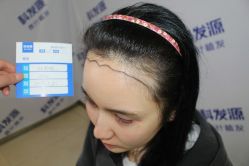 -大麦微针植发丨全国连锁