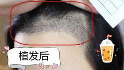 -大麦微针植发全国连锁