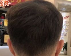 -大麦微针植发全国连锁