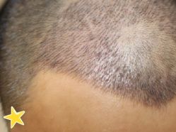 -大麦微针植发丨全国连锁