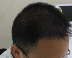 -大麦微针植发全国连锁
