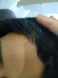 -碧莲盛·不剃发植发