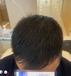 -大麦微针植发丨全国连锁