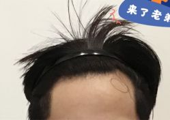 -大麦微针植发全国连锁