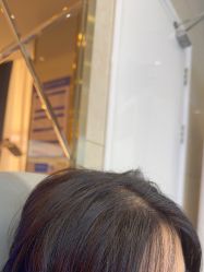 -碧莲盛·不剃发植发