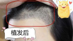 -大麦微针植发全国连锁