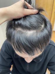 -大麦微针植发全国连锁