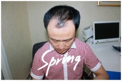 体验后-大麦微针植发全国连锁