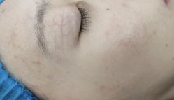 体验前-SKINIST丽铂医疗美容