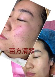 -苗方清颜专业祛痘