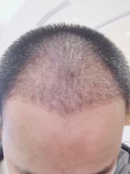 点击看大图 -新生植发·植养护一体