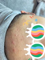 体验前-成都苗方清颜专业祛痘