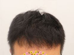 -大麦微针植发全国连锁
