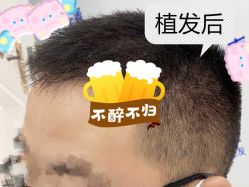 -大麦微针植发全国连锁