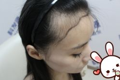 -大麦微针植发丨全国连锁