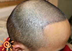 -大麦微针植发丨全国连锁