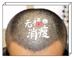 -大麦微针植发全国连锁