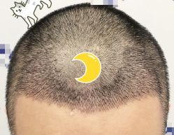 -大麦微针植发全国连锁