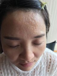 -美丽人生祛斑扁平疣汗管瘤中心
