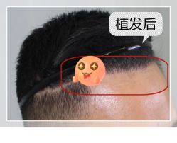 -大麦微针植发全国连锁