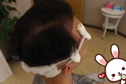 点击看大图 -大麦微针植发丨全国连锁