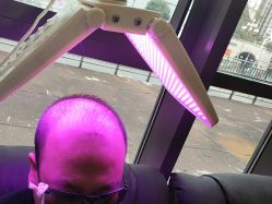 -碧莲盛·不剃发植发