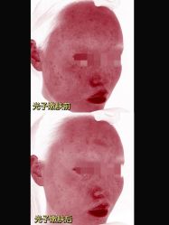 -肌密·水光·祛痘·黄金微针