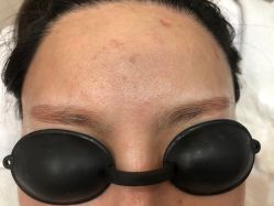 体验前-郡艺医疗美容·微整·眼鼻吸脂