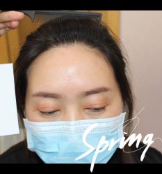 -大麦微针植发全国连锁