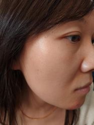 体验后-北京美痣堂古方祛痣斑疣瘊
